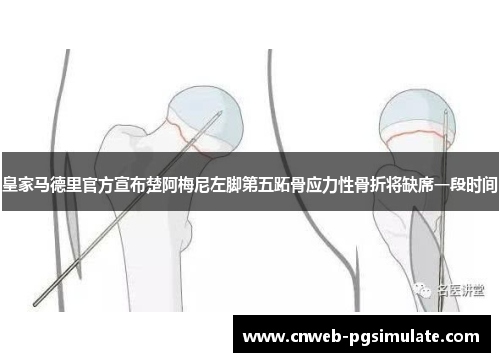 皇家马德里官方宣布楚阿梅尼左脚第五跖骨应力性骨折将缺席一段时间